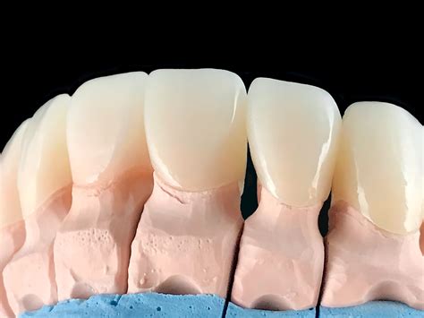 Dental Implants, Bridges, Crowns, Veneers West Kelowna .